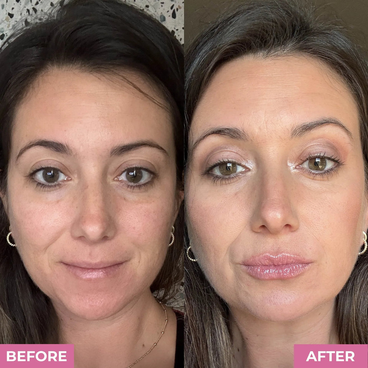 VOLURA™ LIP PLUMPING SYSTEM - Volura